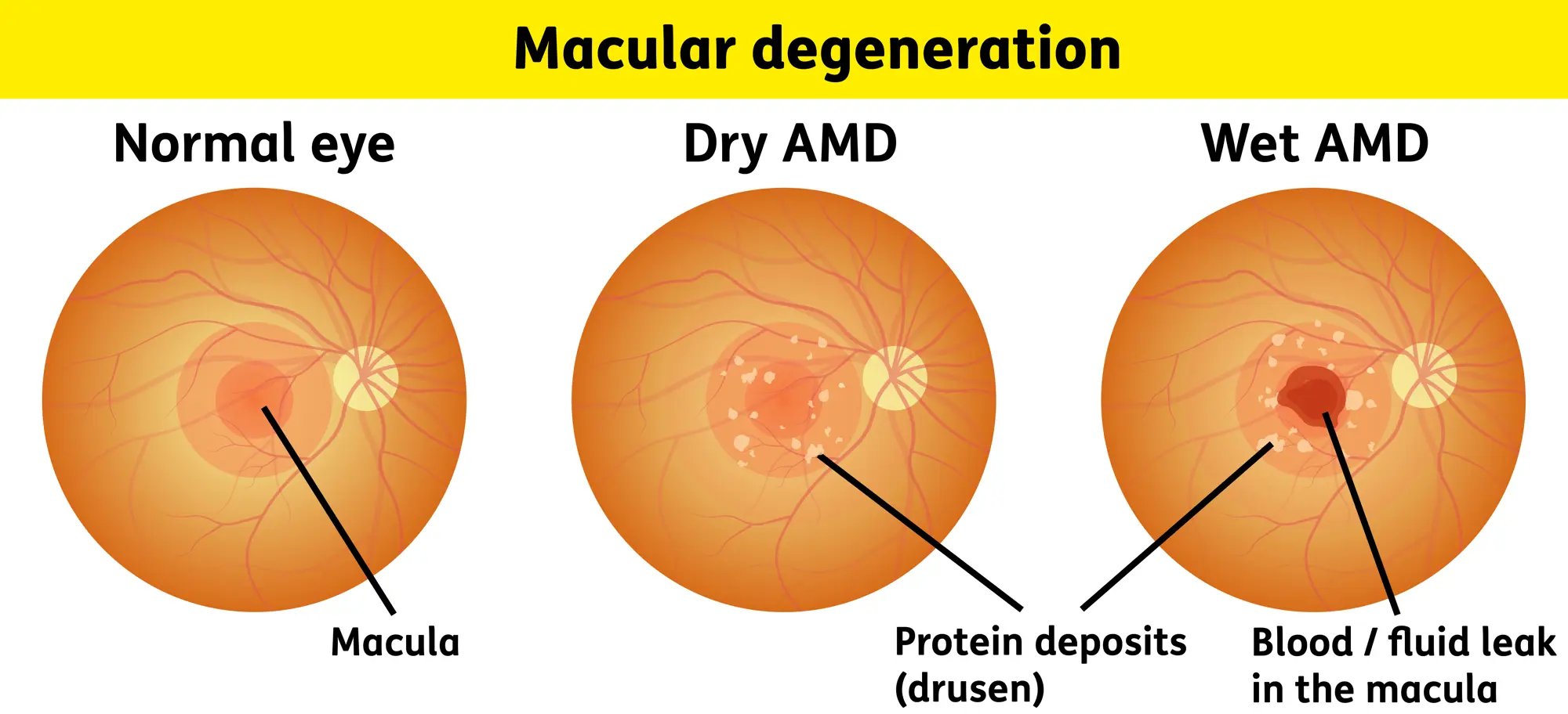 <p>PP: part of retina deteriorates→can’t remove waste</p><p>RF: age<br>FHx<br><strong>cigarette smoking</strong></p><p>E:<br>dry→gradual breakdown of cells in macula<br>wet→new abnormal blood vessels grow under central retina→leaking+bleeding+scarring<br>-exudative<br>-neovascular</p><p>CM: <strong>decreased/blurry central vision</strong><br><strong>slow dark adaptation</strong></p><p>DX:<br>dry:<br>macula→drusen</p><p>wet:<br>retinal exudates<br>neovascularization</p><p>TX:<br>wet→retina specialist referral→anti-vegf injections<br>vision loss→low vision services</p>