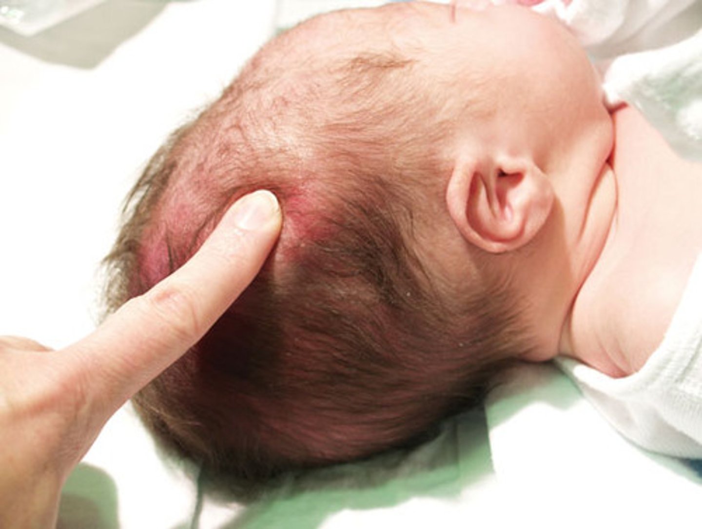 <p>area of edema of the scalp which crosses the suture lines, occurs at presenting part of skull.</p>