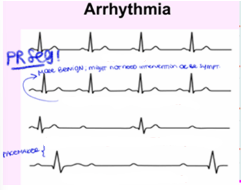 <p>For each ECG in the photo, state what arrhythmia is each (normal, first degree, second degree, third degree) </p><ul><li><p>First degree AV block is defined by what? </p></li><li><p>Second degree AV block, what are the two types and what do they do? Requires?</p></li><li><p>Third degree AV block is a ______ block between what two structures? Requires? </p></li></ul><p></p>