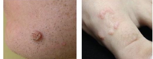 <p>Cutaneous horn/keratotic scale</p><ul><li><p>scale of keratin</p></li><li><p>occurs w/ actinic keratoses and SCC</p></li><li><p>cutaneous horn should be biopsied to r/o SCC</p></li></ul><p>MIMIC: warts</p><ul><li><p>skin-colored/pink</p></li><li><p>often have hemorrhagic punctae (tiny, pinpt spot of bleeding <3mm, appear like small red/purple dots)</p></li></ul><p></p>