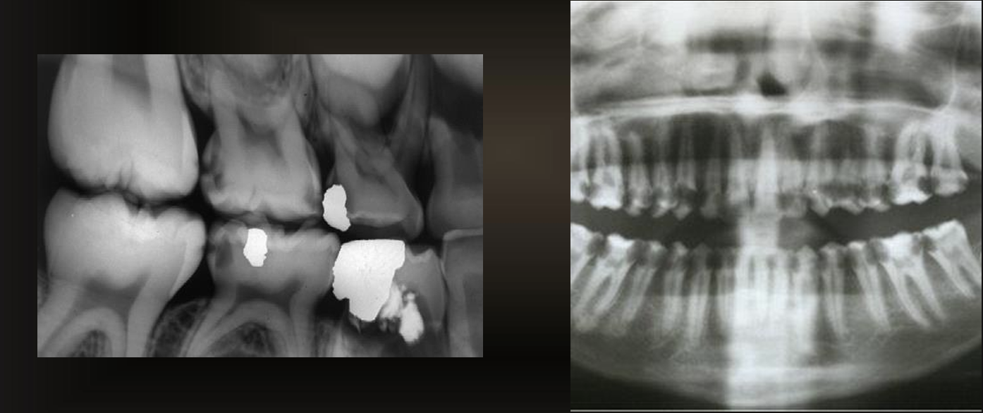 <p>affects almost all teeth- usually caused by radiation </p>