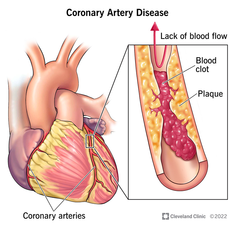 <p>Coronary Artery Disease (CAD) occurs when …?</p>