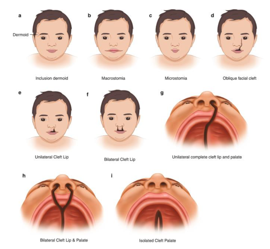 <p>Pathology: Anomalies/ Congenital Disease Example: Facial cleft</p>