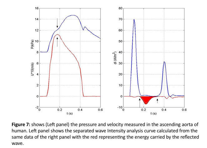<p>d𝐼± = 𝑑𝑃±𝑑𝑈±</p><p>We have</p><p>d𝑃+=1/2 (dP+pcdU)</p><p>dU+=1/2 (dU+dP/pc) (opposite sign for backwards)</p><p></p><p>Therefore </p><p>𝑑𝐼+ = (1/4𝜌𝑐)(𝑑𝑃 +𝜌𝑐𝑑𝑈)²  (opposite sign for backwards)</p>