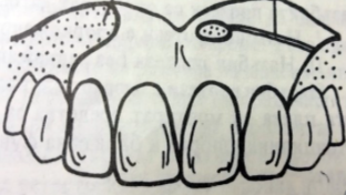 <ol><li><p>mobile teeth</p></li><li><p>retentive alveolar ridge</p></li><li><p>in upper frontal area</p></li></ol><p></p>