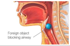 <p>Foreign Body Airway Obstruction</p>