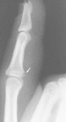<p>occurs when a ligament or tendon pulls fragment of bone away</p>