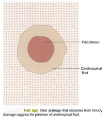 <p>linear fracture at the base of the skull</p><p>-check for halo sign</p>