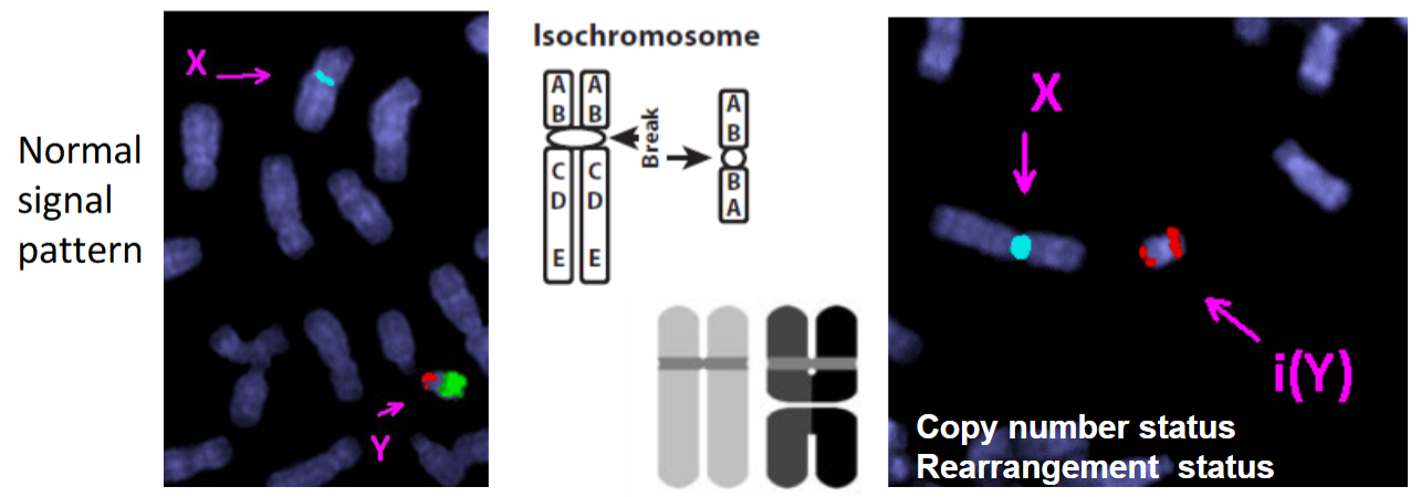 <p>He has a ISOCHROMOSOME of Y</p><ul><li><p>Mistake in centromere division that caused the loss of both the long arms on his Y chromosome</p></li></ul><p></p><p>The deleted region contained lots of genes related to fertility</p><p></p>