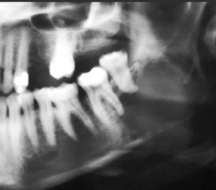 <p>How is this lesion described in terms of periphery?</p>