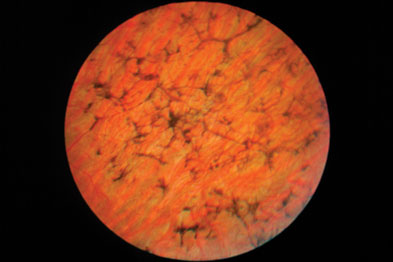 <p>Retinitis Pigmentosa hallmark*</p>