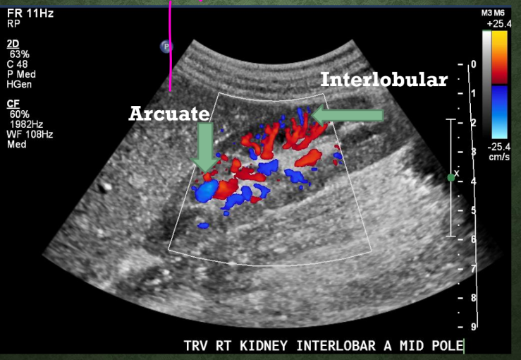 <p>What arteries arise from interlobar arteries?<br>→ Arcuate arteries</p><p>How do arcuate arteries course?<br>→ Parallel to cortical surface</p><p>What arteries arise from arcuate arteries?<br>→ Interlobular arteries</p><p>Where do interlobular arteries extend?<br>→ Cortex</p>