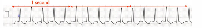 <p><span>What is Orthodromic atrioventricular re-entrant tachycardia (OAVRT)?</span></p>