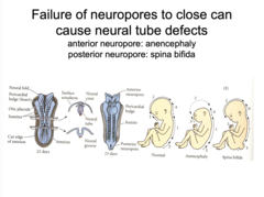 <p>Spina bifida</p>