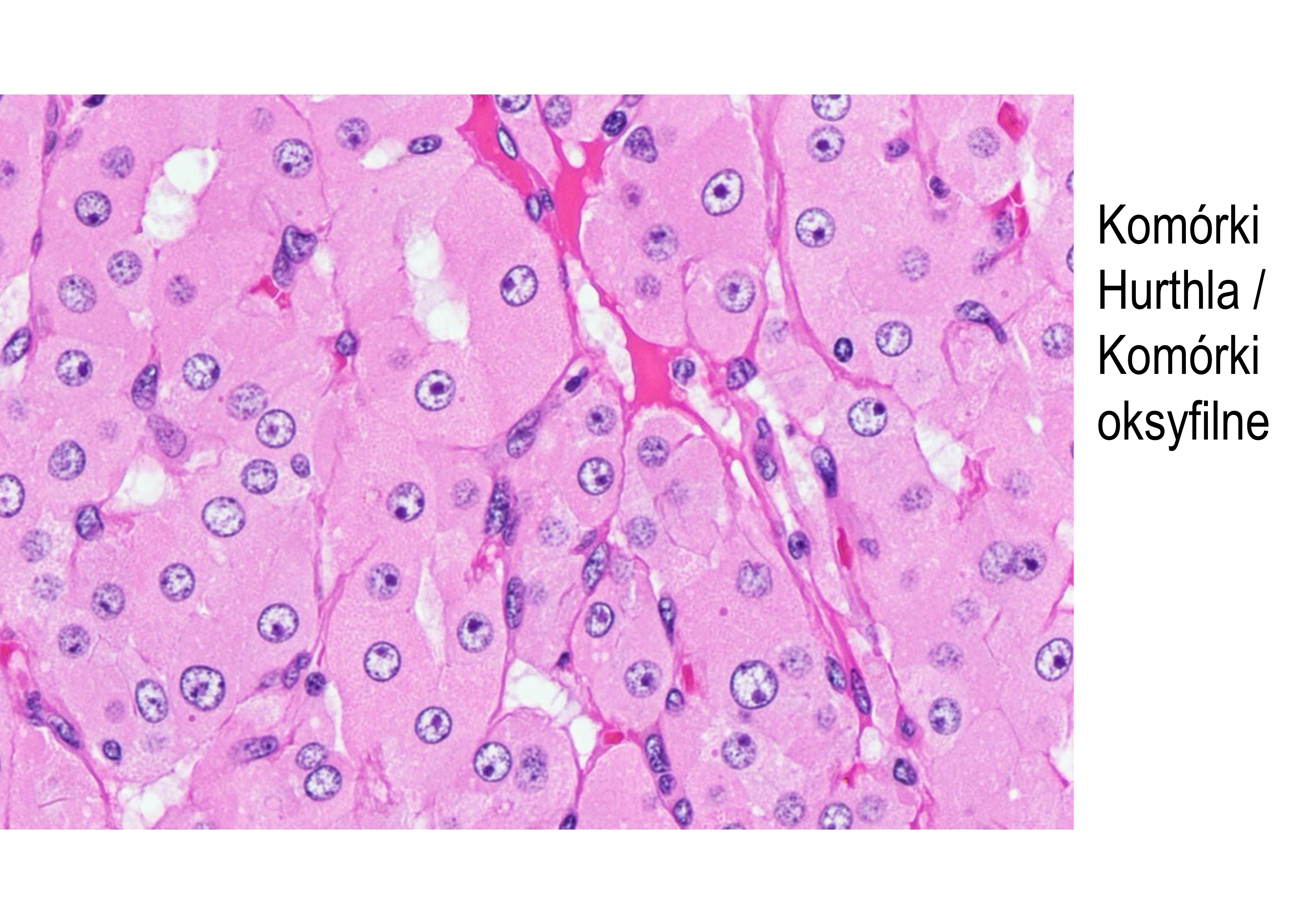 <p>Makroskopowo</p><p>Tarczyca równomiernie i symetrycznie powiększona, w dotyku twarda i krucha</p><p>Powierzchnia przekroju gruczołu jest blada i szarobrązowa</p><p>Mikroskopowo</p><p>Równomierny rozrost tkanki śródmiąższowej tarczycy</p><p>Rozlany naciek miąższu przez komórki zapalne (limfocyty, komórki plazmatyczne) oraz grudki</p><p>chłonne z ogniskami rozmnażania</p><p>Pęcherzyki tarczycowe atroficzne i wyścielone przez komórki Hürthle’a (komórki oksyfilne).</p><p>Są to komórki nabłonkowe o obfitej, kwasochłonnej i ziarnistej cytoplazmie oraz wydatnych</p><p>mitochondriach. Stanowią metaplastyczną odpowiedź adaptacyjną na uszkodzenie</p><p>prawidłowego sześciennego nabłonka pęcherzyków.</p><p>Rzadko może dochodzić do pomniejszenia narządu w wyniku nasilonego włóknienia</p>