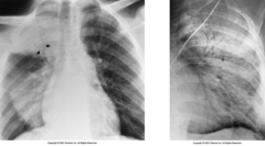 <p>This x-ray image indicates what pathology?</p>