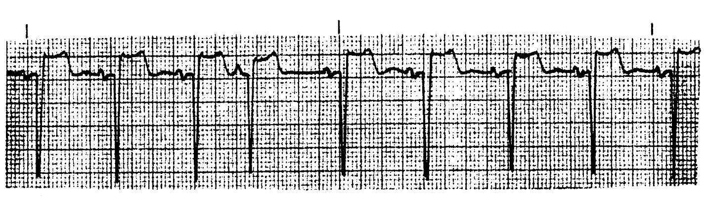 <p>What ECG is this? </p>