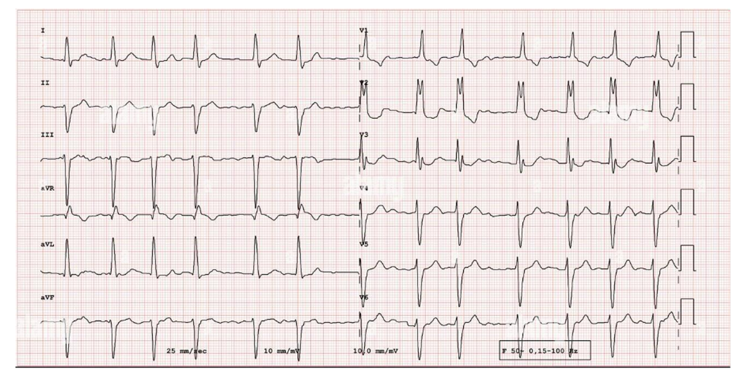 <p><span style="background-color: transparent;">En quin quadrant està situat l’eix elèctric d’aquest ECG?</span></p><p></p><p><span style="background-color: transparent;">a) Desviació a la dreta</span></p><p><span style="background-color: transparent;">b) Desviació l’esquerra</span></p><p><span style="background-color: transparent;">c) Desviació extrema</span></p><p><span style="background-color: transparent;">d) Eix normal</span></p>