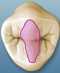 <p>Union of two triangular ridges that cross the occlusal surfaces.</p>