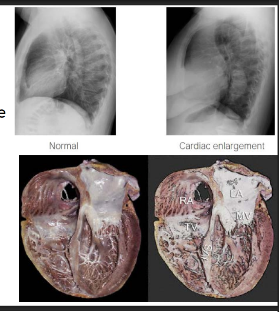 <p>The more blood in, will = more blood out</p><p>LV ENLARGEMENT</p><p>Producing a higher stroke volume compensating for decreased systolic function</p>