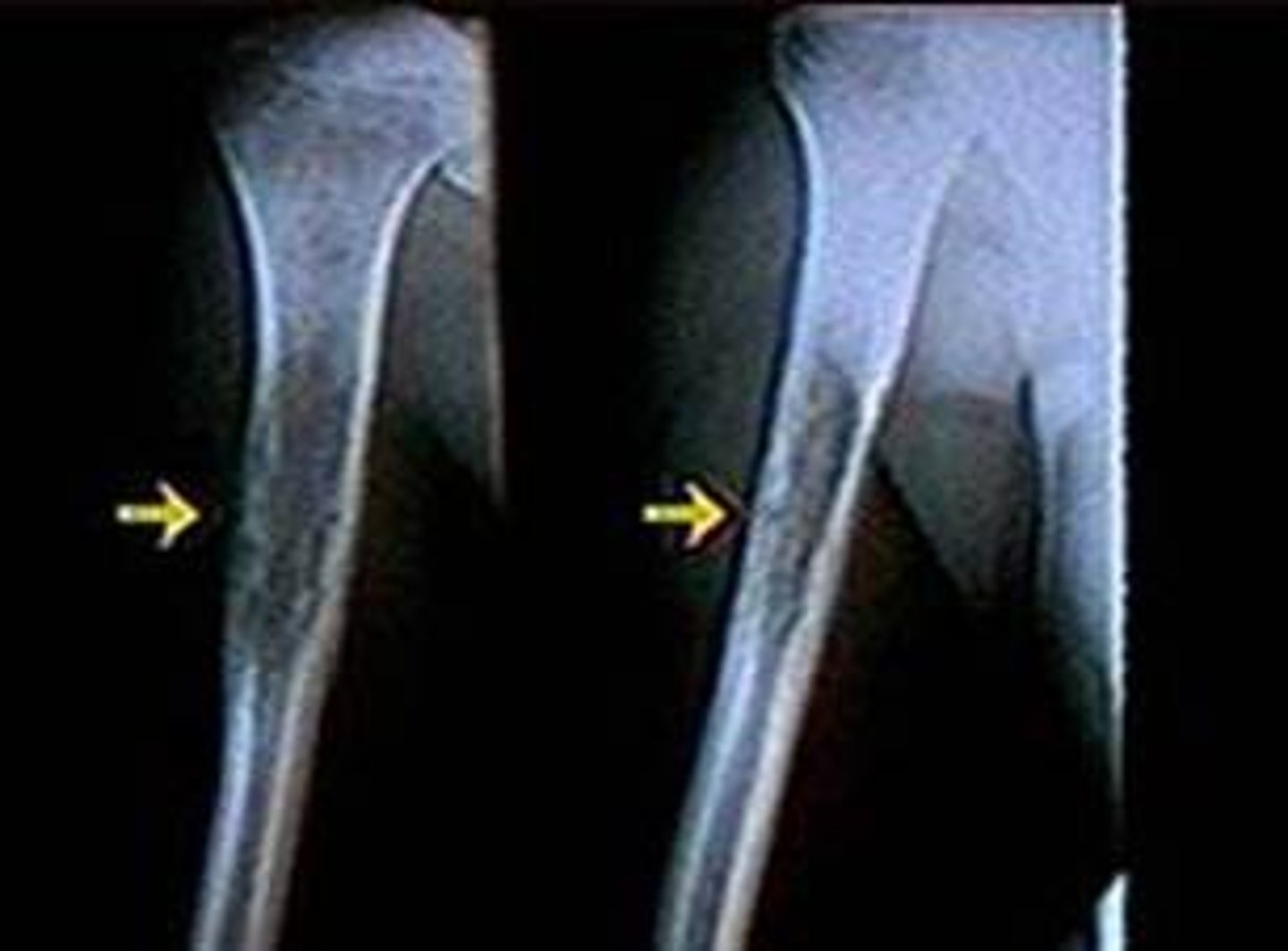 <p>rare malignant tumor arising in bone; most often occurring in children. Pain and swelling are common, especially if the tumor involves the shaft (medullar cavity) of a long bone. This tumor usually occurs at an early age between 5 and 15 years, and combined treatment with surgery, radiotherapy, and chemotherapy represents the best chance for cure (60% to 70% of patients are cured if metastasis has not occurred).</p>