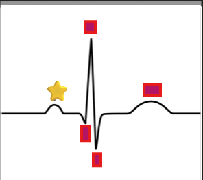 <p>What does the P wave represent on an EKG? </p>
