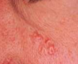<p>Sebaceous hyperplasia - location, pop</p>