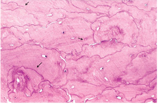 <p>histopathologic feature of paget disease</p>