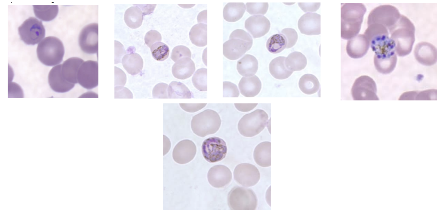 <p>-Infects senescent RBCs (small to normal)</p><p>-Ring form 1/3 size of RBC, thick</p><ul><li><p>Bird’s eye</p></li></ul><p>-Mature trophs = band and basket forms</p><ul><li><p>Do not fill RBC</p></li><li><p>Prominent pigment</p></li></ul><p>-Schizont has 6-12 merozoites</p><ul><li><p>Rosette forms</p></li></ul><p>-Gametocyte can fill RBC</p><p></p>