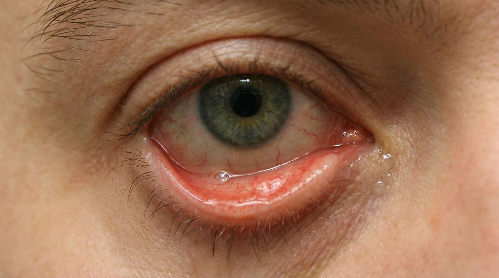 <p>lower eyelid loose and rolling outward</p>