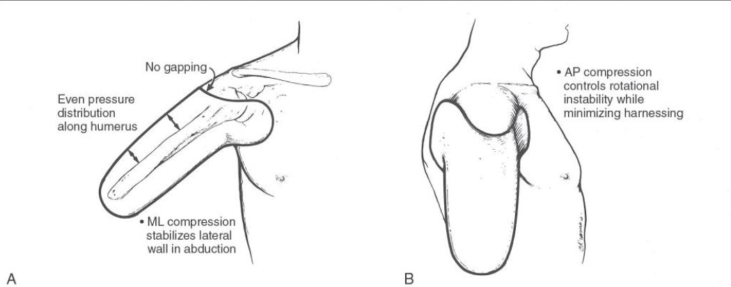 <ul><li><p>anterior and posterior wings for suspension </p></li><li><p>lower trimline laterally (between acromion and end of deltoid)</p></li><li><p>used for mid to long transhumeral amputations</p></li></ul><p></p>