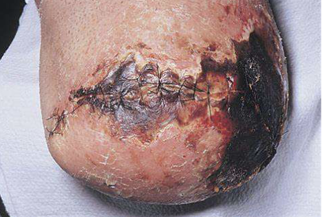 <p><span>Infection/ Necrotic tissues</span></p>