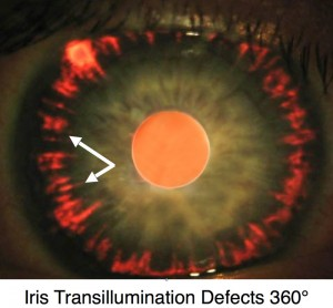 <p>Radial midperipheral iris transillumination defects caused by loss of pigment from the iris.</p>