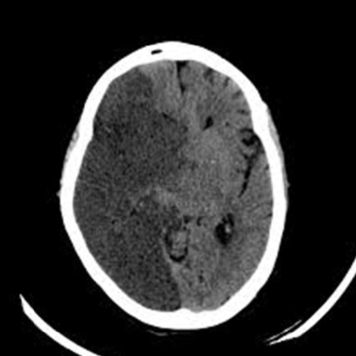 <p>pt has contralateral hemiplegia, hemisensory loss, and homonymous hemianopia (b/l symmetric loss of vision in half the visual fields) w eyes deviated to side of lesion</p>