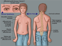 <p>Erb-Duchenne palsy (superior trunk [C5-C6] brachial plexus injury: "waiter's tip")</p>
