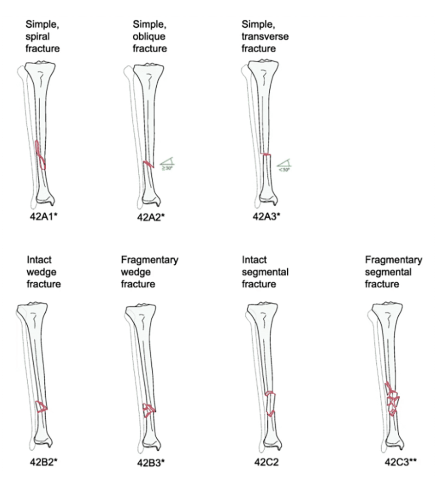 <p><strong>AO/OTA Tibial Shaft Fracture Classification</strong></p>