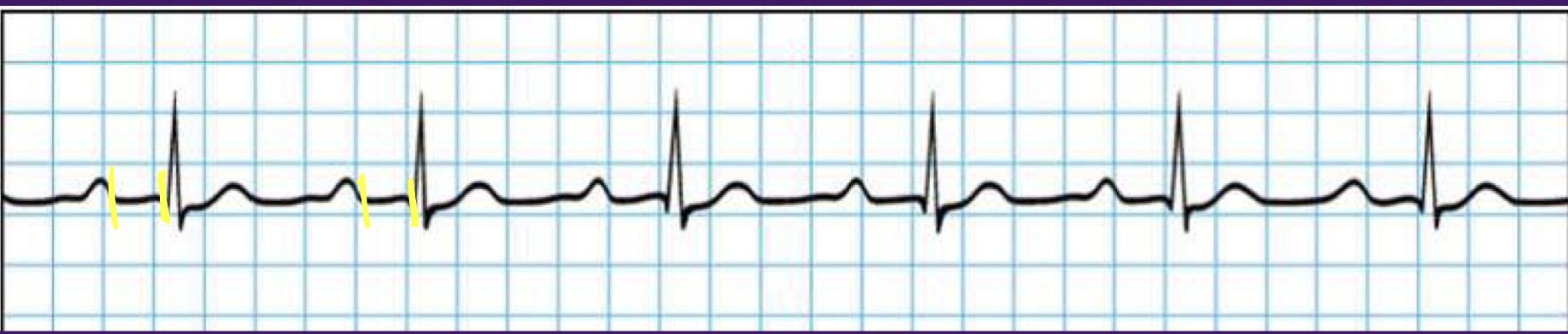 <p>Heart block - 1st degree</p>