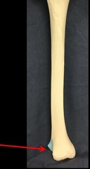 <p>lateral notch on the distal end tibia where tibia and fibula articulate</p>