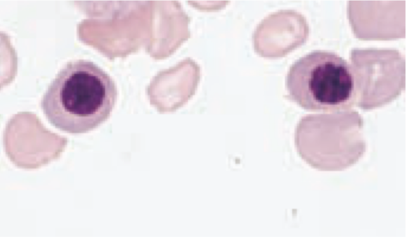 <p>4th stage of erythrocyte formation</p><ul><li><p><strong>diameter: </strong>10-15 micrometers</p></li><li><p><strong>nucleus:</strong> </p><ul><li><p>low nucleus:cell ratio</p></li><li><p>solid, blue-black nucleus that begins to degenerate that contains nonlinear clumped chromatin</p></li><li><p>nuclear chromatin is heavily condensed</p></li><li><p>at the end of this stage, nucleus is fragmented/structureless</p></li><li><p>phase contrast microscopy: can observe cytoplasmic projections protracting and retracting</p><ul><li><p>preparing for nucleus ejection</p></li></ul></li></ul></li><li><p><strong>cytoplasm:</strong></p><ul><li><p>after final mitotic division, concentration of hemoglobin increases within → <strong>pink/salmon color, but slight tinge of blue</strong></p></li></ul></li><li><p>not able to divide at this stage or moving forward bc the cell can’t perform DNA synthesis</p></li><li><p>maturation time: 48 hrs</p></li></ul><p></p><p></p>