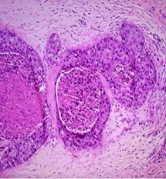 <p>What type of DCIS?</p>