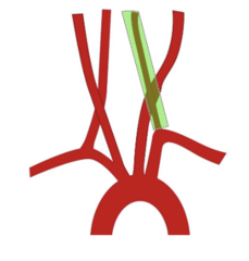 <p>left subclavian steal happens when there is an occlusion of the left subclavian proximal to the origin of the left vertebral artery; results in reverse flow where blood in the left vertebral artery flows away from the brain & towards the left subclavian artery</p><p>this increases risk of cerebral ischemia!! </p><p>symptoms: sycnope, vertigo, ataxia &/or hemiplegia; arm ischemia is also present; neck flexion + exercise can exacerbate the symptoms </p><p>pulse is absent or significantly weaker in the affected arm & blood pressure can be 20 points lower than the contralateral arm </p><p>subclavian endarterectomy is treatment of choice</p>