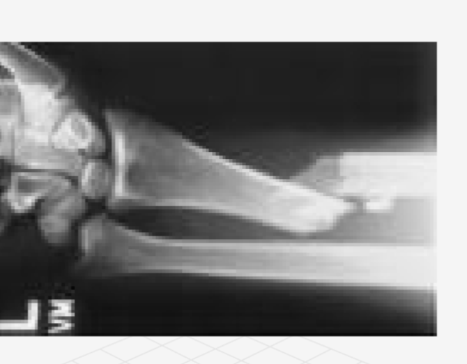 <p>what type of fracture</p>