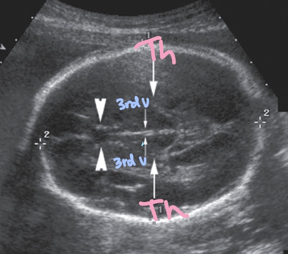 <p>Located on Both sides of third ventricle and conencted by massa intermedia/ interthalamic adhesion </p>