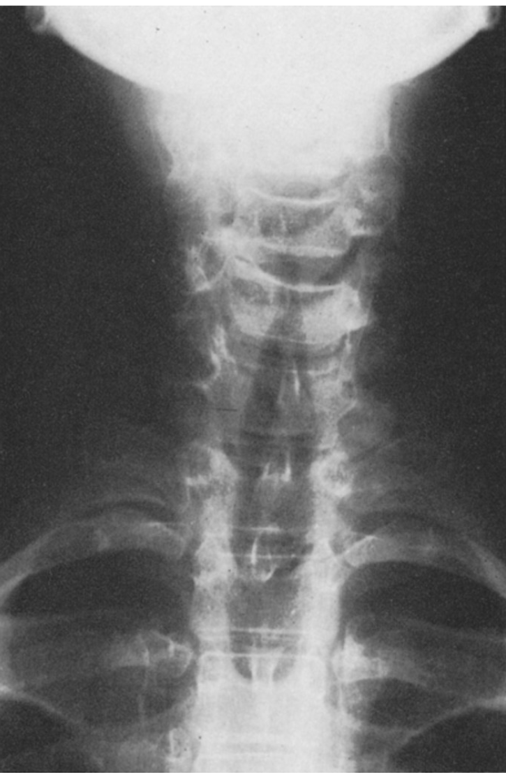 <p>Contra lateral pedicle hypertrophy and sclerosis </p>