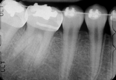 <p>increase number of roots, both dec &amp; perm, most commonly affect man 3rd molar > cuspids and bicuspids, no tx but detection important if endo needed</p>