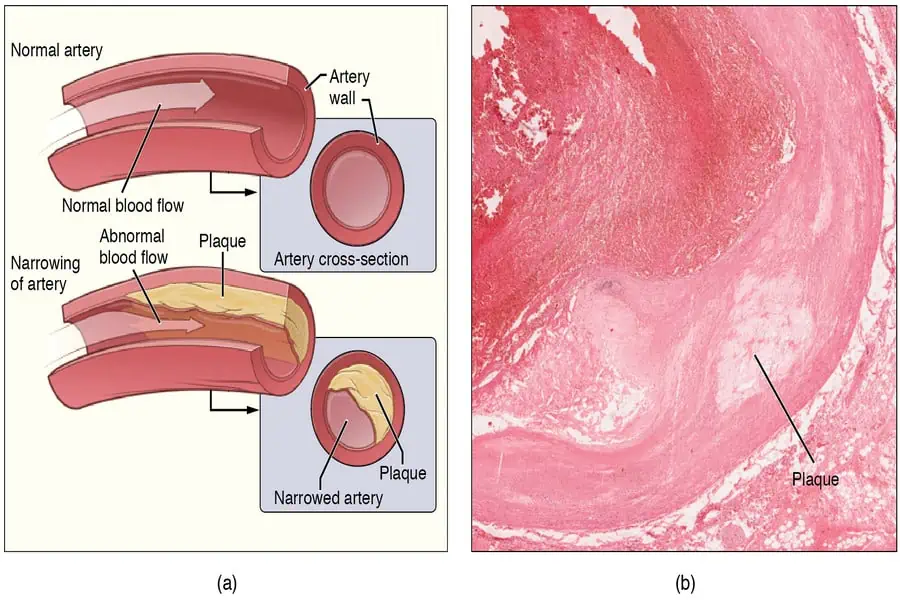 <p><span style="background-color: transparent; font-family: "Times New Roman", serif;">Atherosclerosis is a chronic inflammatory response to vessel wall injury, resulting in a "pimple" of fat and scarring inside an artery.</span></p>