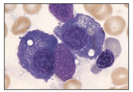 <p>Multiple Myeloma</p>