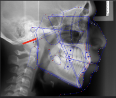 <p>which anatomical landmark:</p><p>- Intersection of the mandible with the temporal bone</p><p>- Not an anatomic structure</p>