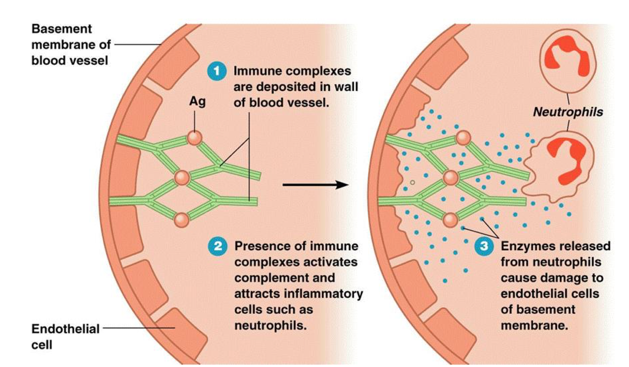 <p>SLE/Lupus</p>