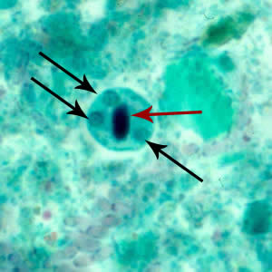 <p>Trophozoite with small central karyosome and fine chromatin, may have some RBC ingestions </p><p>Cyst has 4 nuclei with a rounded bar of chromatin</p>